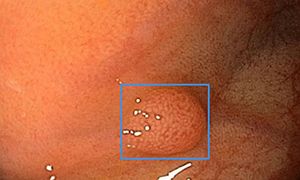 Image: An example of the way the CADe system highlights a polyp.