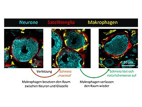 Drei mikroskopische Bilder, die die Studie zusammenfassen - von der Verletzung in den Schmerz und Schmerzauflösung. Makrophagen besetzen Raum zwischen Neuron und Gliazelle und verlassen den Raum bei der Schmerzauflösung wieder. 