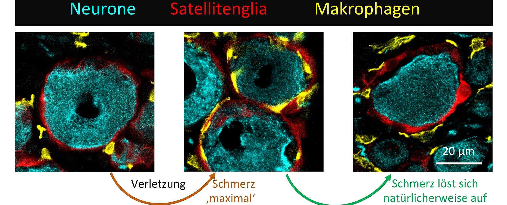 Drei mikroskopische Bilder, die die Studie zusammenfassen - von der Verletzung in den Schmerz und Schmerzauflösung. Makrophagen besetzen Raum zwischen Neuron und Gliazelle und verlassen den Raum bei der Schmerzauflösung wieder.