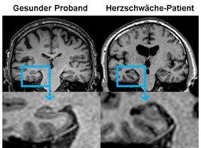 Vergleich Herz gesunder und Herzschwäche-Patient