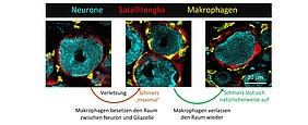Grafische Zusammenfassung der Schmerzrückbildung  von Verletzung über maximalem Schmerz bis zur Schmerzauflösung - Makrophagen besetzten erst den Raum zwischen Neuron und Gliazelle, dann verlassen sie ihn wieder.