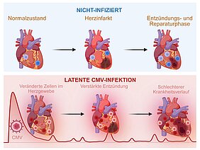 Oben der Verlauf eines Herzinfarktes bei einer nicht CMV-infizierten Person: Normalzustand, Herzinfarkt, Entzündungs- und Reparaturphase; unten der Verlauf bei einer latenten CMV-Infektion: Veränderte Zellen im Herzgewebe, verstärkte Entzündung und schlechterer Krankheitsverlauf. 