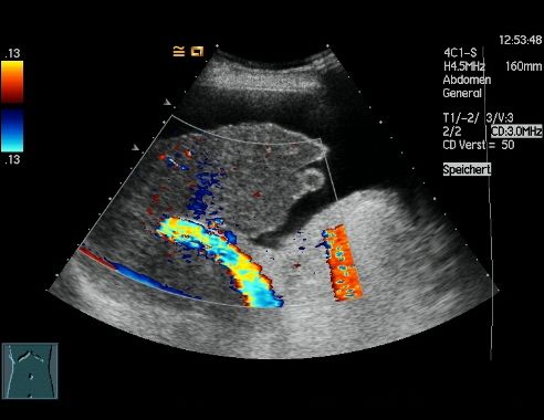 Sonografisches Bild einer Leberzirrhose.
