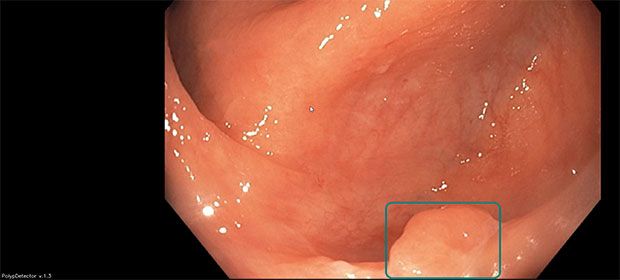 An example of the interface, displaying recording information in the upper left corner, the AI version in the lower left corner, and the endoscopic image with AI boundary boxes in the center.