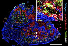 Immunfluoreszenzaufnahme einer Lymphknotenmetastase. Deutlich erkennbar ist die enge räumliche Interaktion von Tumorzellen, fibroblastischen Retikulumzellen und myeloiden Zellen. Grün markiert sind CD11B-positive myeloide Zellen, rot Pan-Cytokeratin-positive Brustkrebszellen (epithelialen Ursprungs), und blau Kollagen I, das von fibroblastischen Retikulumzellen gebildet wird. Maßstabsbalken: 500 µm, Inlay: 30 µm.