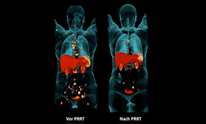 Illustrationsbild: Vergleichsbild vor und nach PRRT