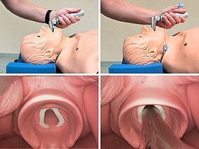 Collage mit vier Bildern an einer Patientenpuppe - Laryngoskopie- und Intubationsvorgang
