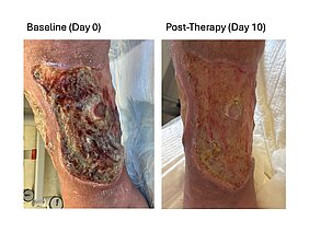 Chronische Wunden vor der Behandlung mit Probiotika und nach den 10 Therapietagen.