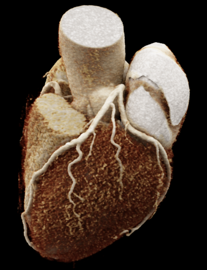 Das Bild zeigt eine CT-Aufnahme des Herzens und der Herzkranzgefäße 