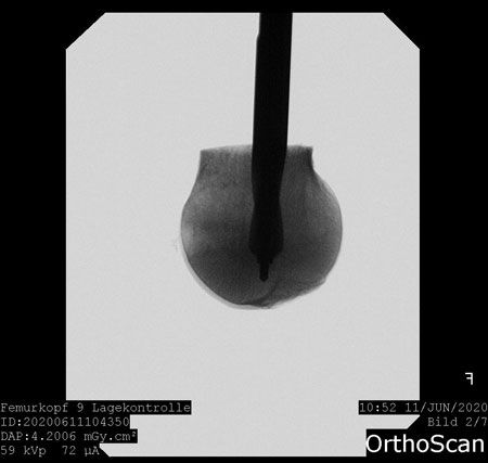 Foto einer Augmentation von Implantaten (hier Schenkelhalsklingen)