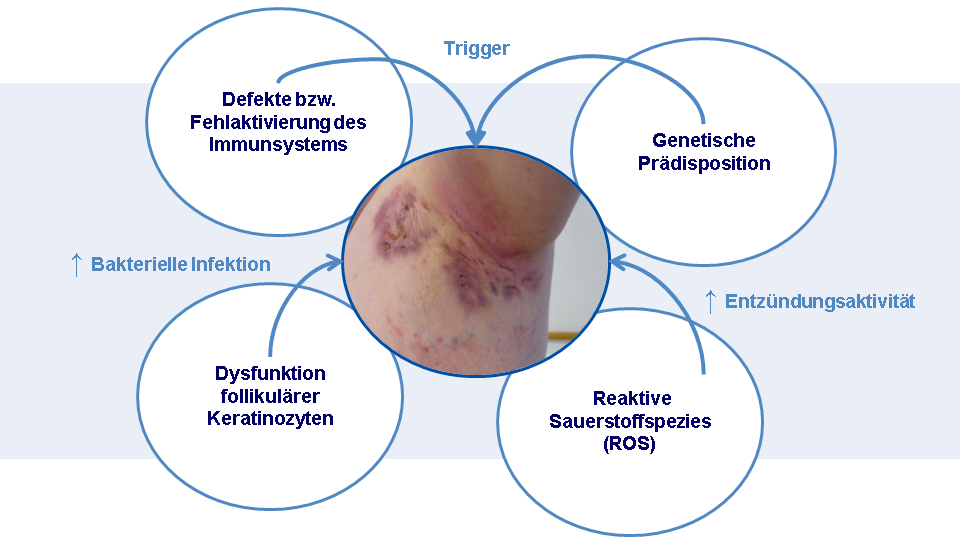 Schaubild der bekannten pathogenetischen Einflussfaktoren bei Acne inversa.