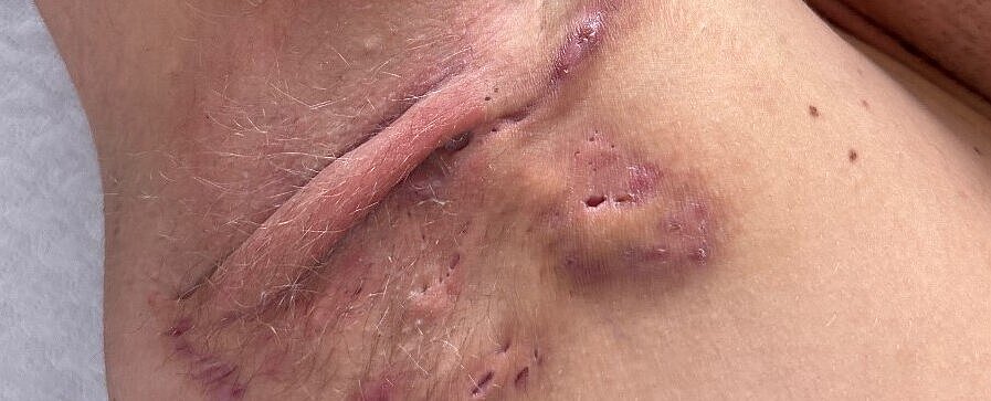 Hautkrankheit Hidradenitis suppurativa Das Bild zeigt Knoten und Falten unter der Achsel eines Patienten.