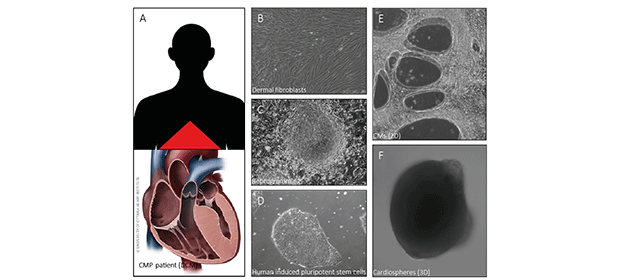 Inherited cardiomyopathy patients (e.g. dilated cardiomyopathy) donate skin samples to allow us the investigation of the disease specific mutation (A). Out of the skin we are obtaining dermal fibroblasts (B) to reprogram the cells (C) into patient specific human induced pluripotent stem cells (hiPSC, D). These hiPSCs are differentiated in vitro into cardiomyocytes (heart muscle cells, CMs) to generate a 2D monolayer of contracting CMs (E) or a 3D cardiosphere model (F).