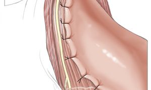 Illustrationsfoto: Schematische Darstellung einer Fundoplicatio nach Dor.