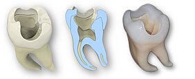 2 Ansichten eines 3D-gedruckten Zahnes und eines Querschnitts