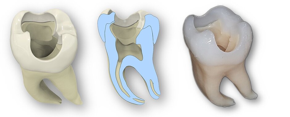 2 Ansichten eines 3D-gedruckten Zahnes und eines Querschnitts