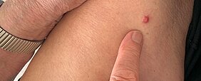extramedulläres Myelom zu sehen ist ein kleines extramedulläres Myelom auf dem Oberschenkel eines Patienten. Sein Finger zeigt auf den kleinen roten, leicht erhobenen Punkt, der wie eine Blase aussieht.