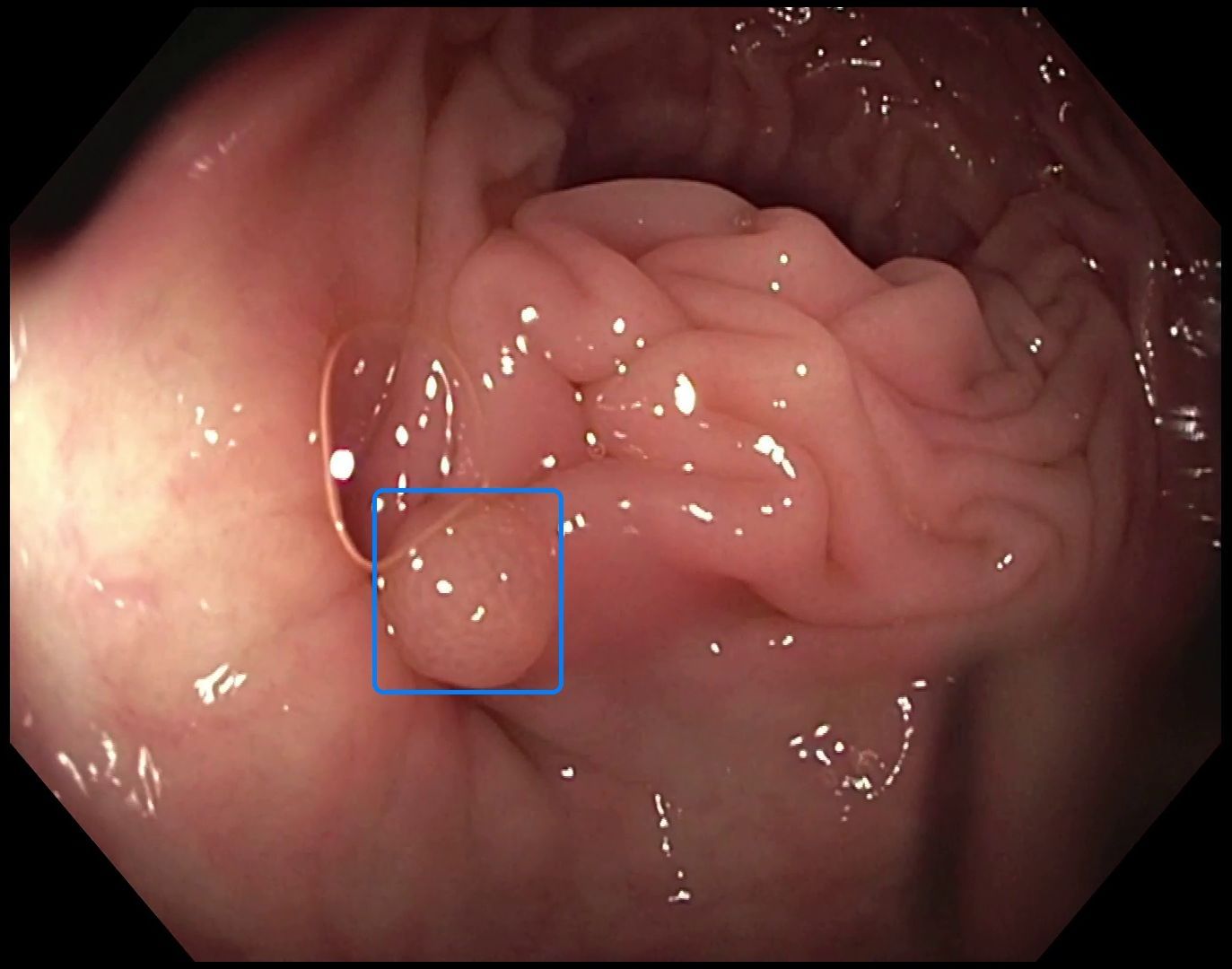Image of polyp detection with AI