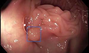 Image of polyp detection with Artificial Intelligence