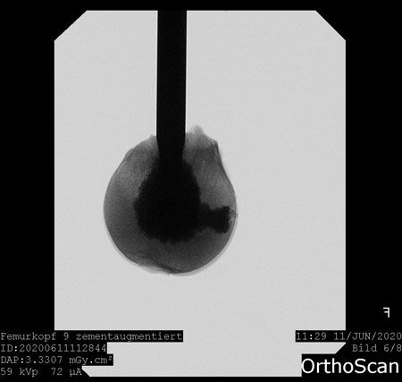 Foto einer Augmentation von Implantaten (hier Schenkelhalsklingen)