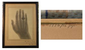 Foto zeigt eine der ersten Röntgenaufnahmen Albert von Köllikers Hand. Rechts die Markierung, die vom Rahmen des Bildes verdeckt war.