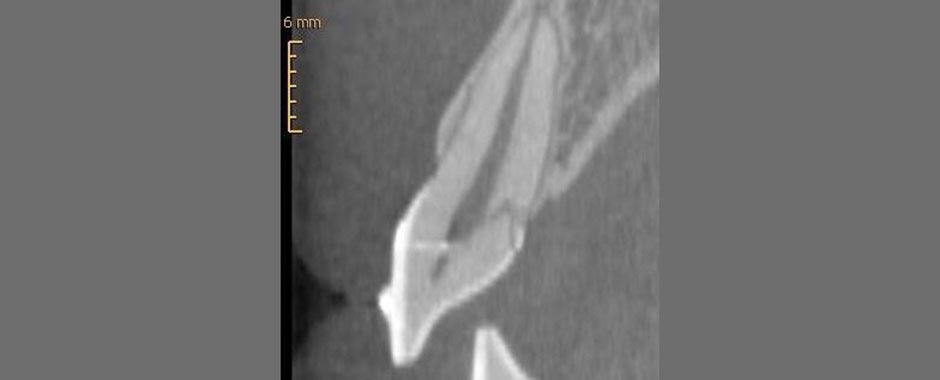 Röntgenbild einer Zahnextrusion