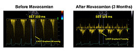 2 Bilder der LVOT-Gradienten