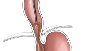 Illustrationsfoto: zeigt, wie der Ballonkatheter mittels Endoskop im Übergangsbereich zwischen Speiseröhre und Magen platziert wird.