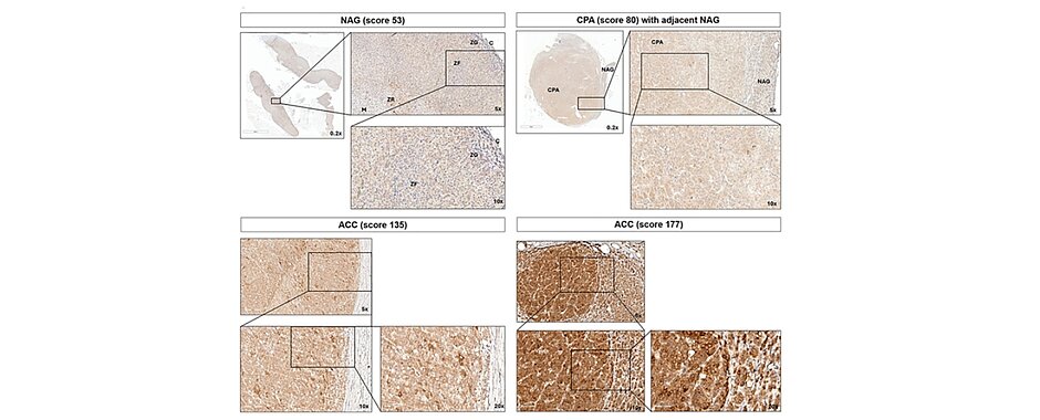 Mikroskopische Aufnahmen aus der Endokrinologie von Nebenniere, Adenom und Karzinom.