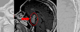 Ein roter Pfeil auf der MRT-Aufnahme zeigt auf einen ebenfalls in rot eingekreisten Tumor. 
