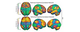 Hirnnetzwerke bei Parkinson und Alzheimer Die Grafik zeigt verschiedene Abbildungen von Hirnnetzwerken bei Parkinson und Alzheimer mit farblich markierten Bereichen der stimulierten Gegenden.