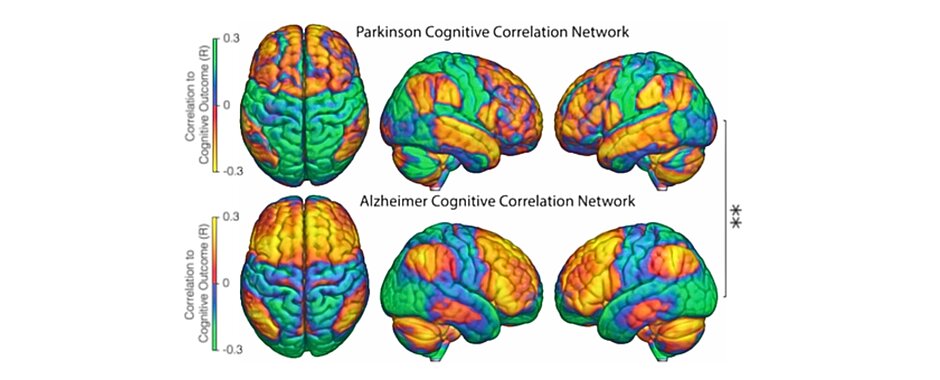 Die Grafik zeigt verschiedene Abbildungen von Hirnnetzwerken bei Parkinson und Alzheimer mit farblich markierten Bereichen der stimulierten Gegenden.