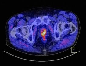 Das Bild zeigt, wie markant ein Prostatakarzinom unter Zuhilfenahme des Tracers PSMA im PET-CT als gelb-rotes Objekt dargestellt wird.