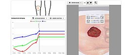 Wunderkint-App Das Bild zeigt einen Screenshot des Dashboards für Ärzte, oben der abfotografierte Bereich des Körpers, rechts die Wunde mit Referenzkarte und unten links die Kurven der verschiedenen Skalen. rechts