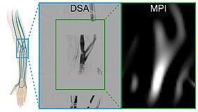 Links ist ein Arm mit Gefäßstrukturen skizziert, Mitte eine DSA-Aufnahme eines bestimmten Bereiches des Arms und rechts eine MPI-Aufnahme. 