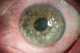 Keratoplastik: Zentrale Hornhaut wegen Narbe durch Transplantat ersetzt