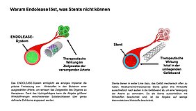 Die Grafik zeigt, was ENDOLEASE kann, was Stents nicht können, nämlich Wirkstoffe in die Arterie abgeben, Stent hält Gefäß offen und gibt Wirkstoffe in die umliegende Gefäßwand ab, aber nicht in den Blutfluss. 