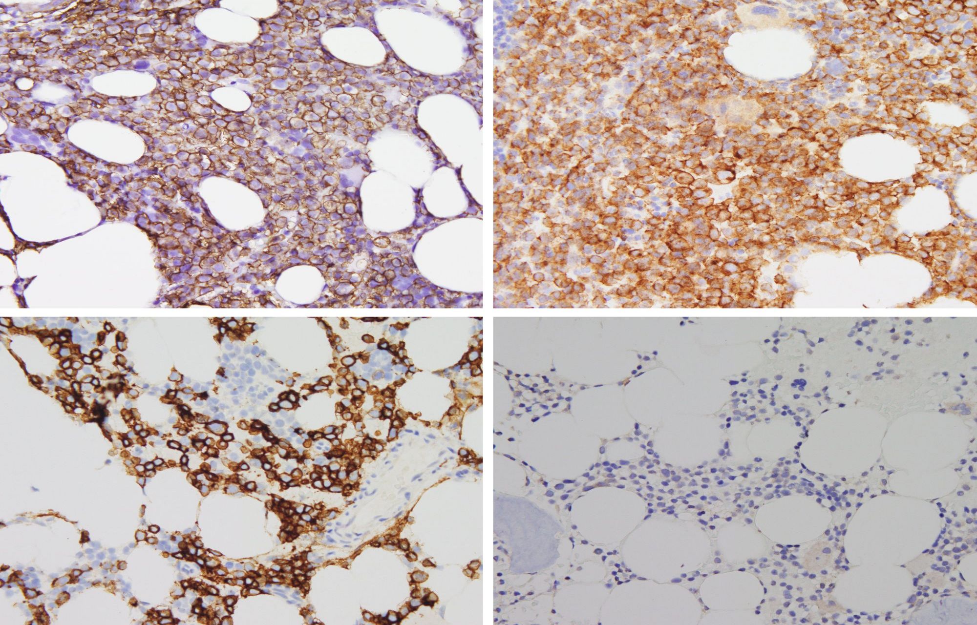 Collage aus vier mikroskopischen Bildern von CD138-positiven Myelomzellen mit und ohne GPRC5D. 