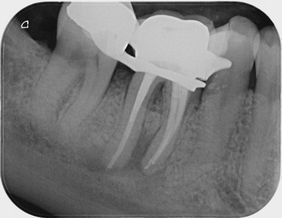 Ein Beispiel für eine exzellente endodontische Leistung: Die preiswürdige, von Lisanne Carnier durchgeführte Wurzelkanalbehandlung.