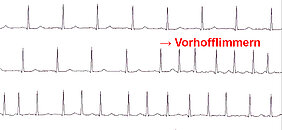 EKG mit Vorhofflimmern.