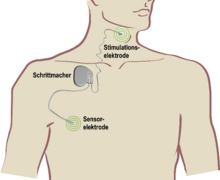 Grafik Implantat eines Zungeschrittmachers