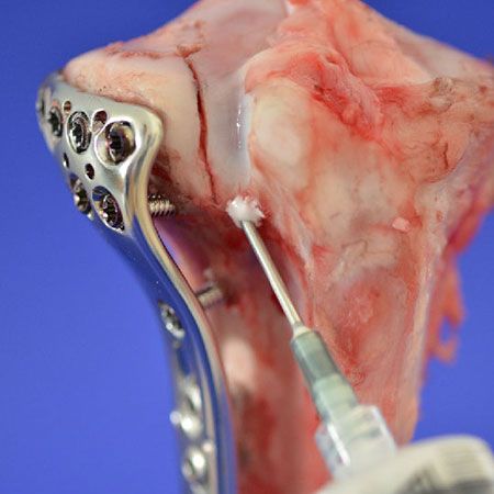 Foto von Injizierbaren Knochenzementen zur gelenknahen Knochendefektauffüllung im Frakturmodell