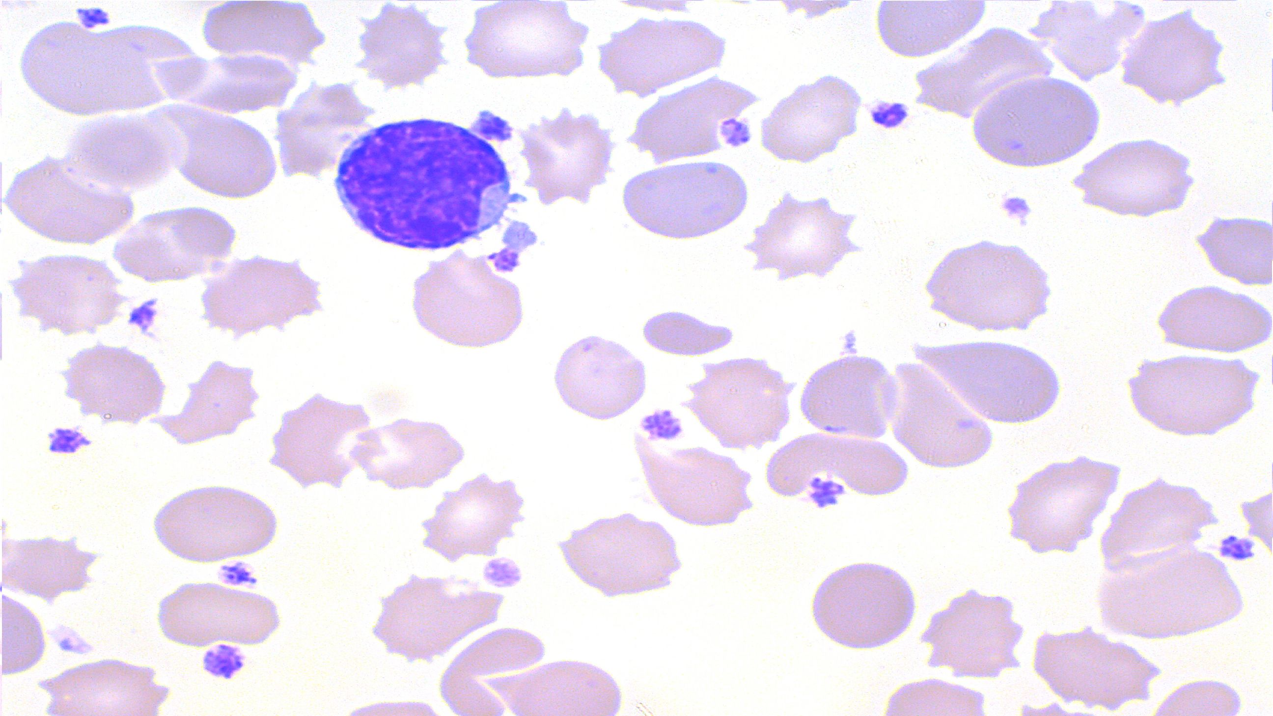 Auf dem Bild sieht man rote Blutkörperchen neben violett angefärbten Blutplättchen 