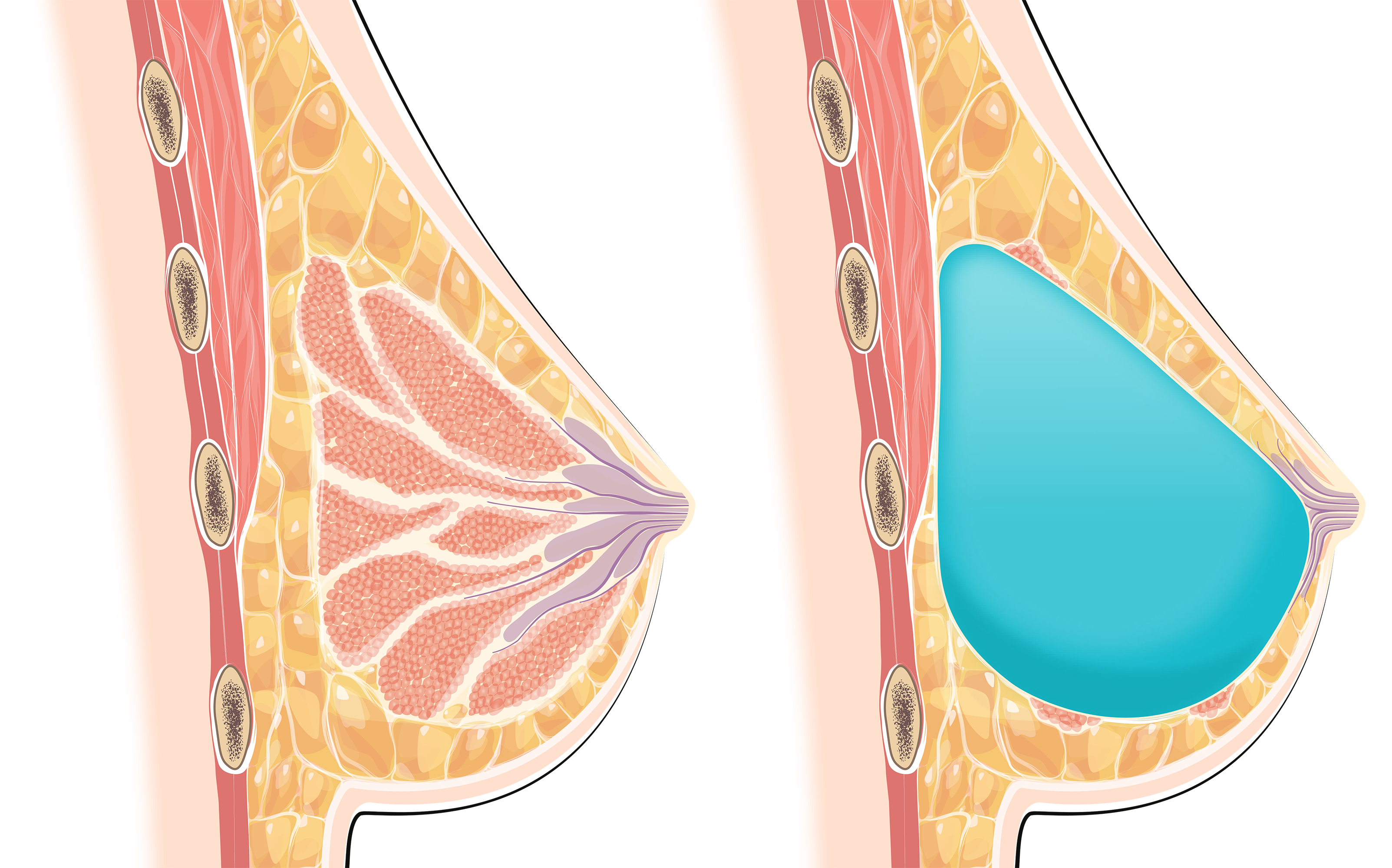 Illustration: Links eine Brust mit natürlichem Gewebe und rechts eine Brust mit Implantat
