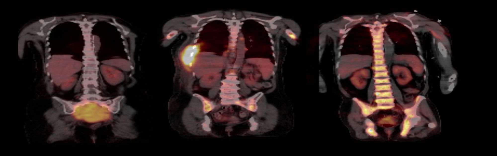 Das Bild zeigt auf drei PET-Bildern Tumorherde an unterschiedlichen Stellen des Skeletts.