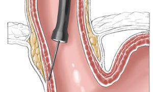 Illustrationsfoto: wie mit dem Endoskop Botulinumtoxin in die Muskulatur der Speiseröhre injiziert wird.