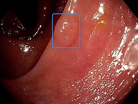 Bei einer Koloskopie wird ein Polyp mit einem blauen Rechteck markiert. 