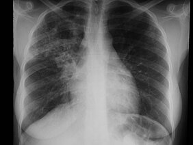 Ein typischer Röntgenbefund einer offenen, übertragungsfähigen Tuberkulose mit einer Kaverne im rechten Oberfeld der Lunge.