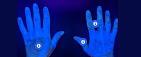 Häufige Fehler bei der Handhygiene werden anhand eines Bildes von (absichtlich) schlecht aufgetragenen fluoreszierenden alkoholischen Handeinreibungen unter UV-Licht veranschaulicht.
