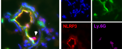 NLRP3 Inflammasom Collage aus fünf mikroskopischen Aufnahmen